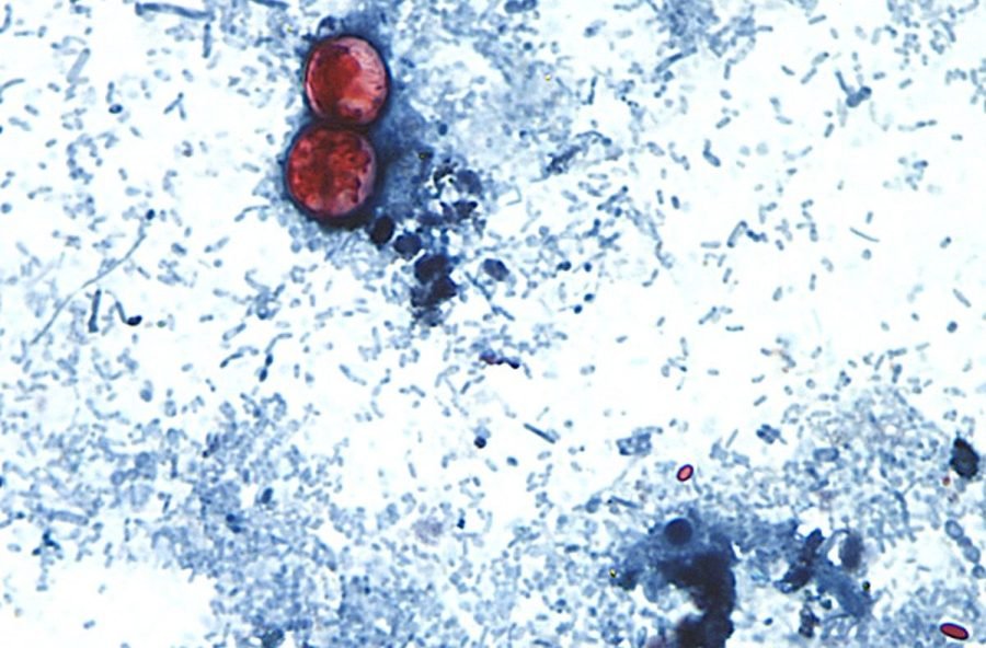 More than 18,200 cyclosporiasis cases now suspected in US: Where it's getting worse