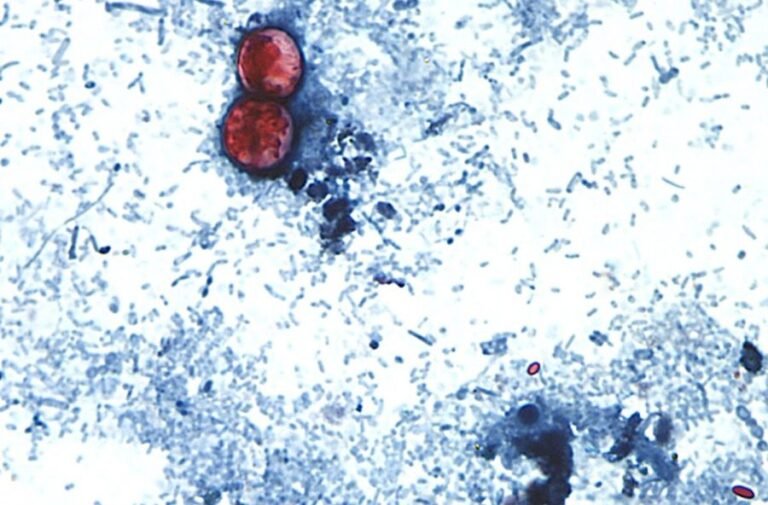 Why cyclospora can be deadly for some people