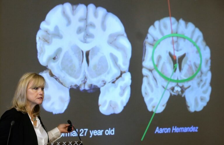 1 in 4 NFL players suffer from brain disease. Where is the accountability?