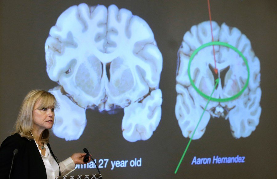 1 in 4 NFL players suffer from brain disease. Where is the accountability?